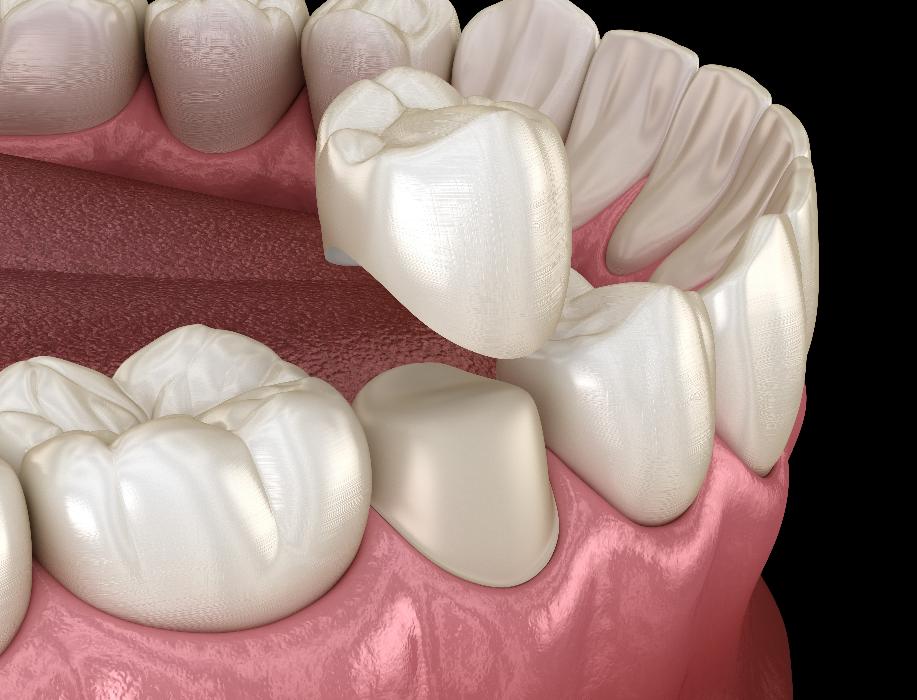 close up of dental crown | dental crown oakbrook terrace il