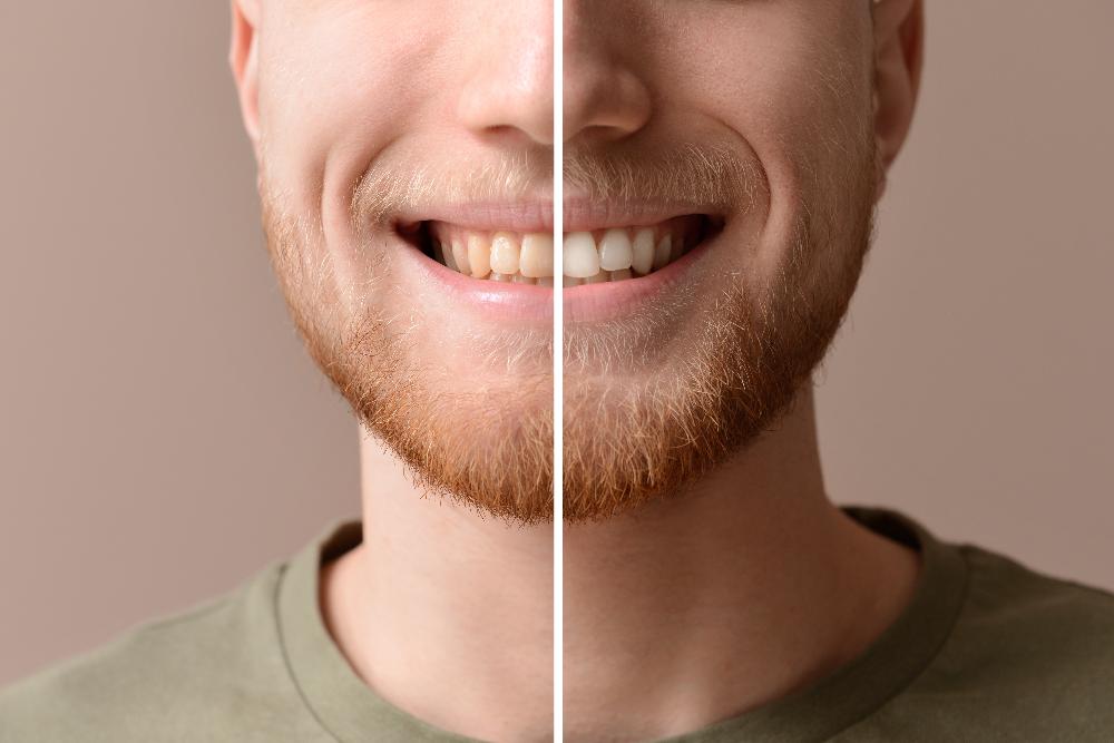 patient teeth whitening before and after | teeth whitening oakbrook terrace