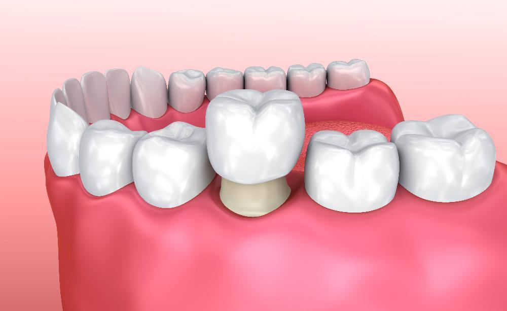 dental crown diagram in oakbrook terrace