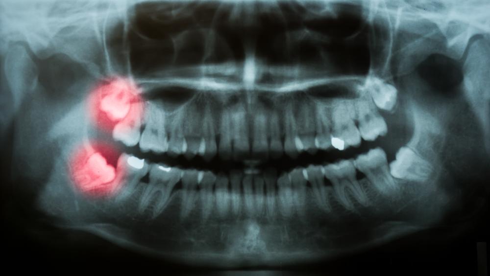 digital dental x-rays in Oakbrook terrace