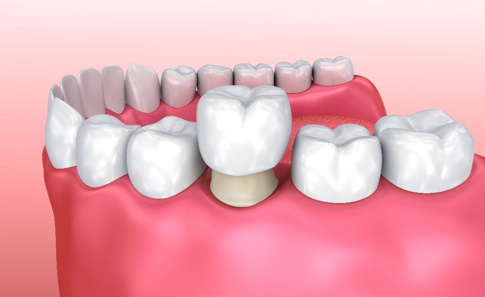 close up of dental crown on tooth | dental crowns oakbrook terrace il