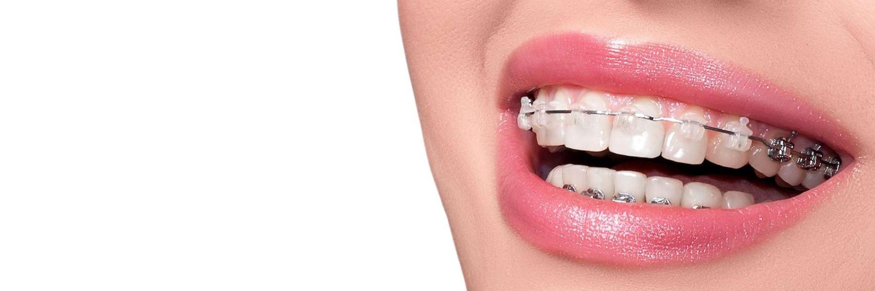 close up of traditional braces | dentist oakbrook terrace