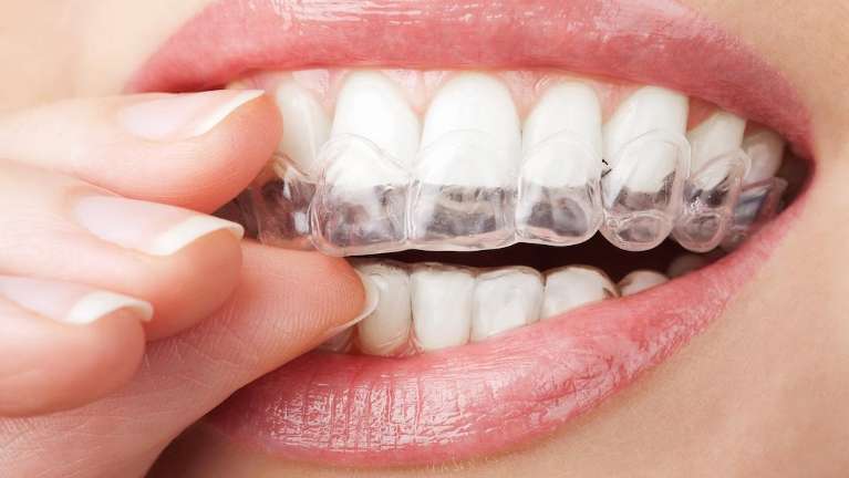 Woman putting in Invisalign in Oakbrook Terrace